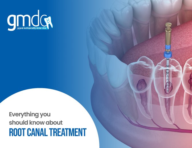 Root Canal Treatment